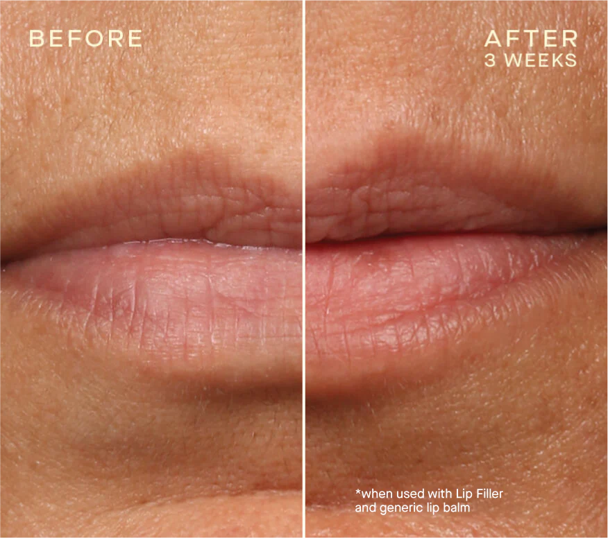 Lip Filler with Subtopical Plumping Technology